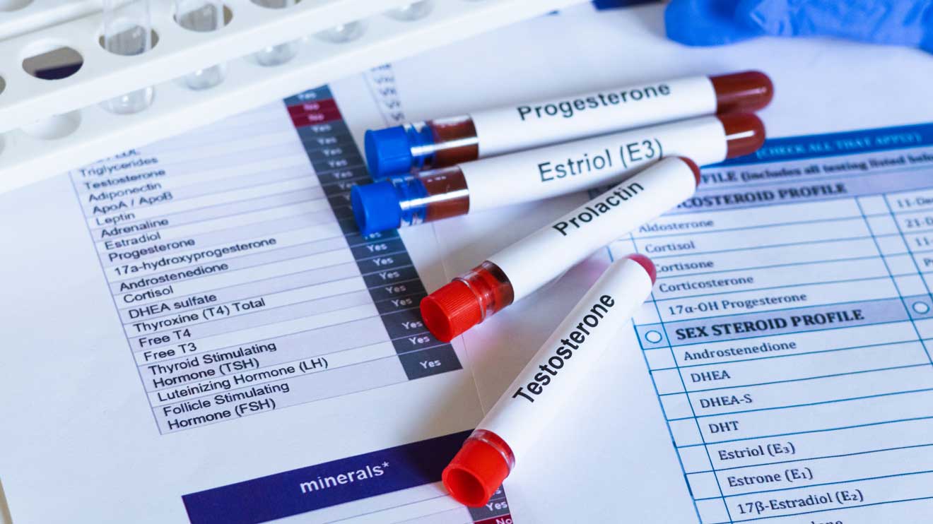Ein Hormonstatus ist immer eine Momentaufnahme. Ein Blutwert kann unauffällig aussehen, obwohl eine Frau deutliche Wechseljahresbeschwerden hat.  - iStock/Emilija Milenkovic 