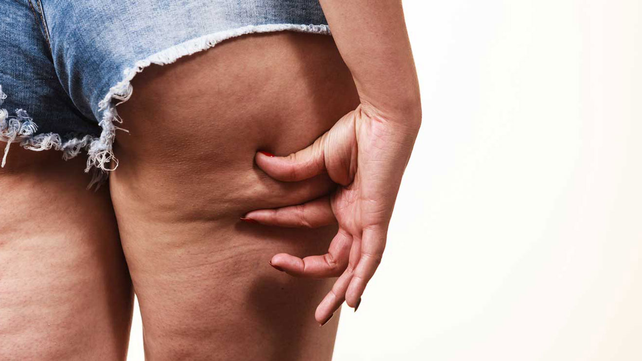 Das Erscheinungsbild der Cellulite kann sich in der Menopause verschlechtern. Man spricht daher auch von Menopause-Cellulite.  