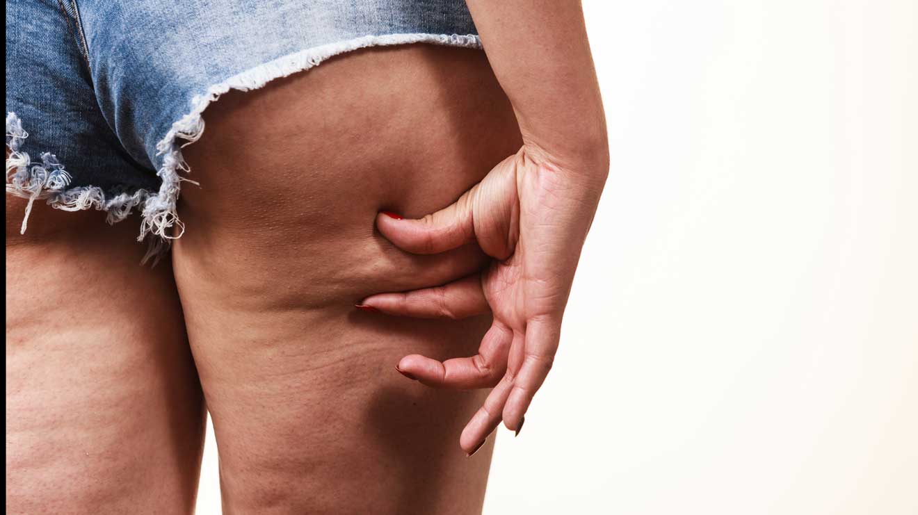 Das Erscheinungsbild der Cellulite kann sich in der Menopause verschlechtern. Man spricht daher auch von Menopause-Cellulite.   - iStock/Anetlanda